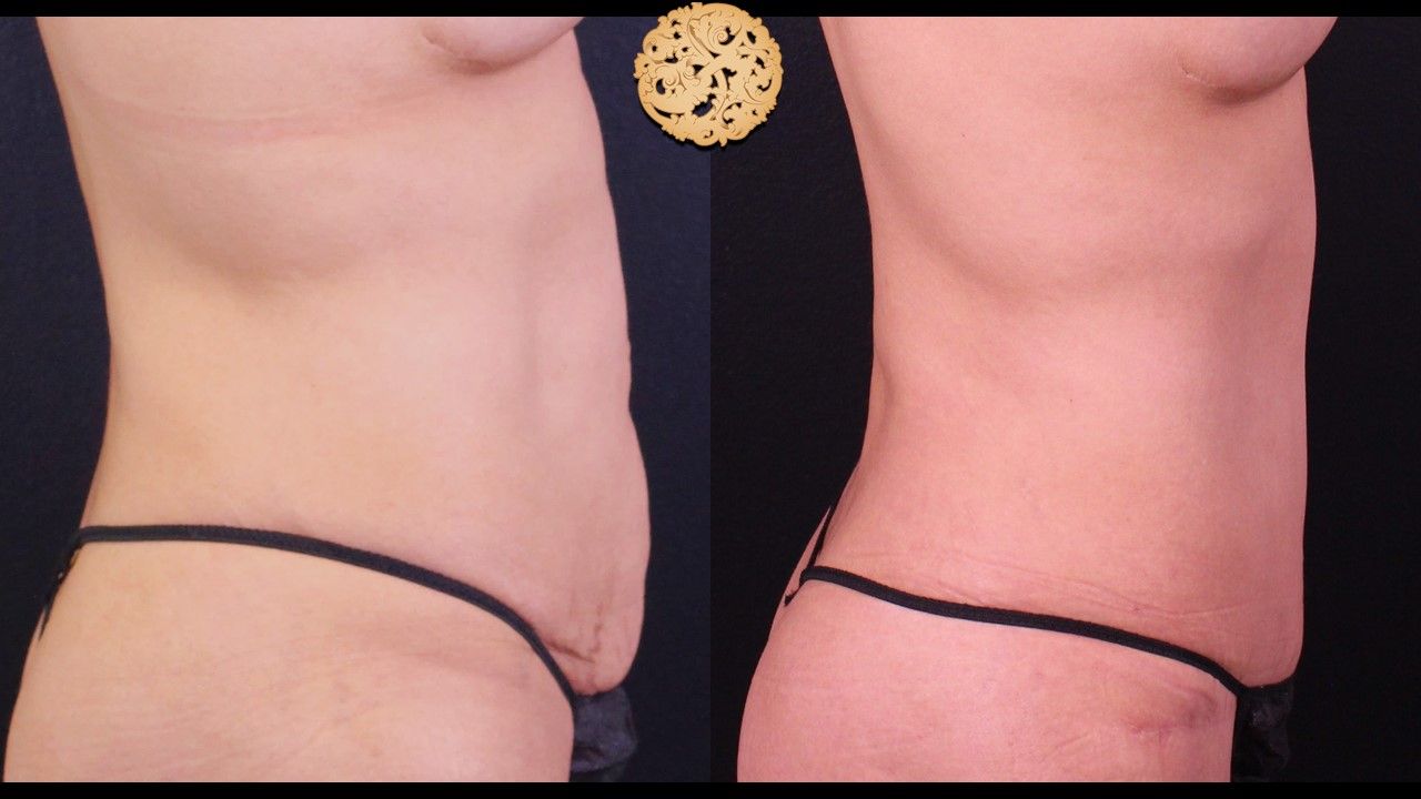 Tummy Tuck Before & After