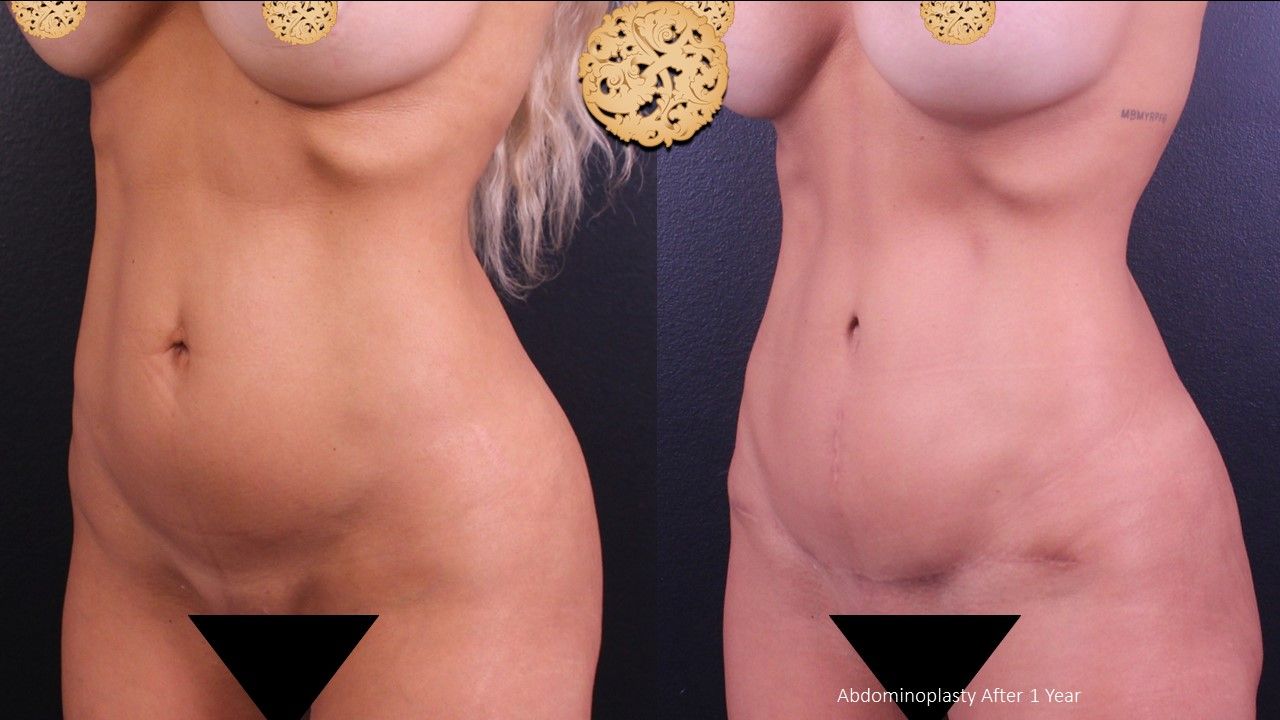 Tummy Tuck Before & After
