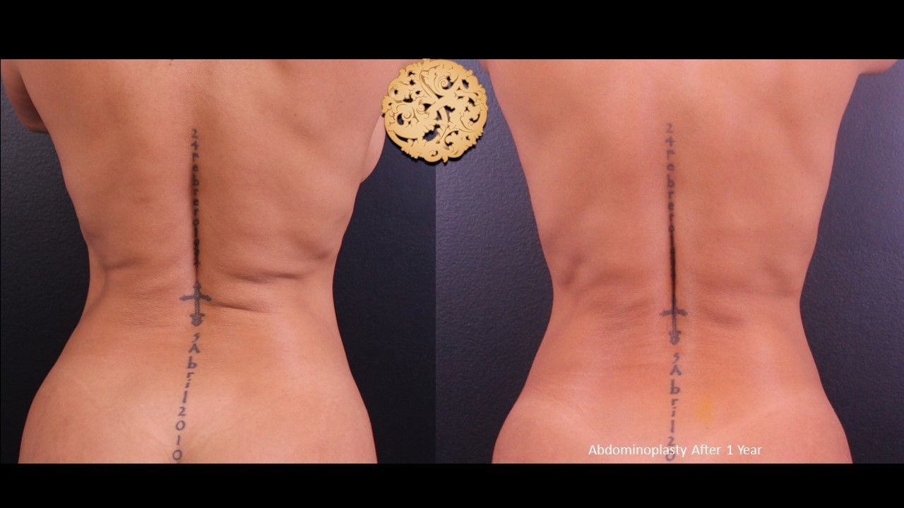 Tummy Tuck Before & After
