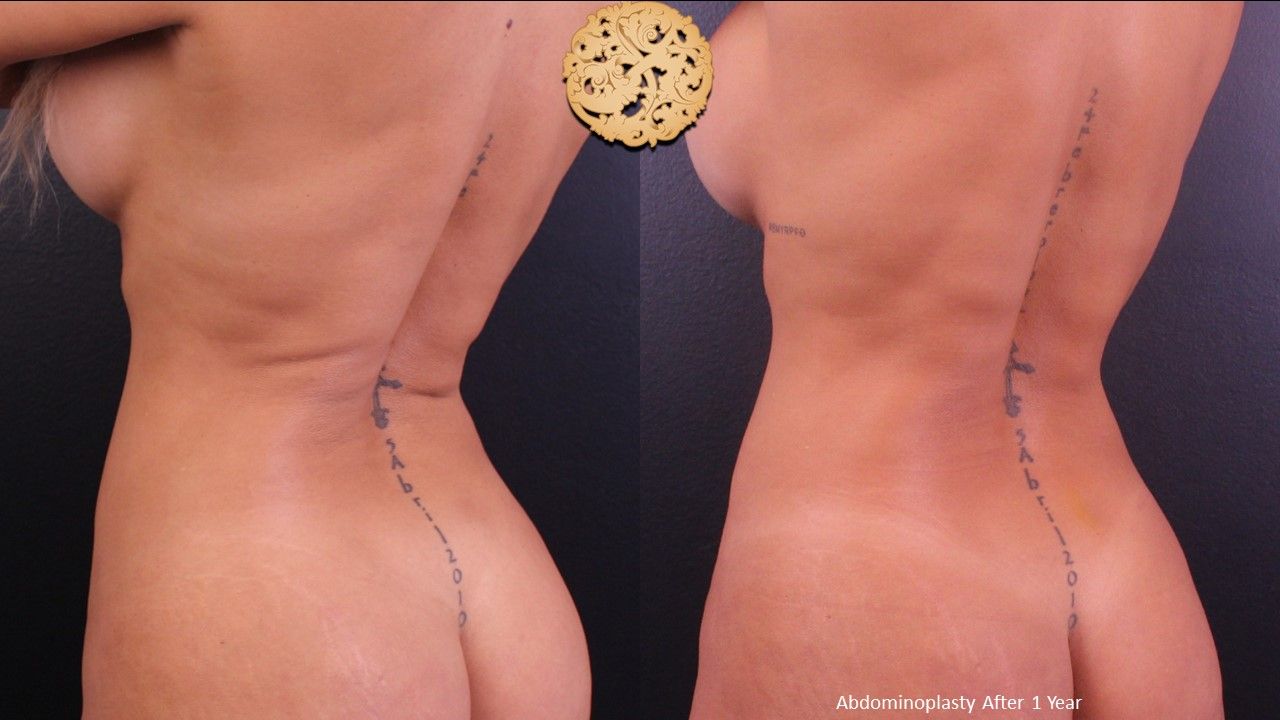 Tummy Tuck Before & After