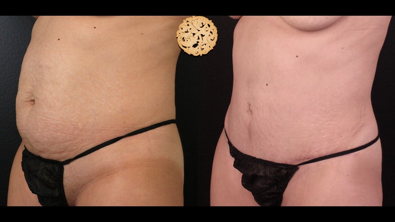 Tummy Tuck Before & After