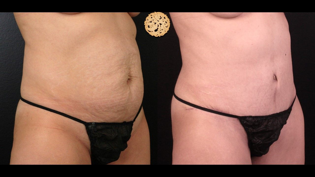 Tummy Tuck Before & After