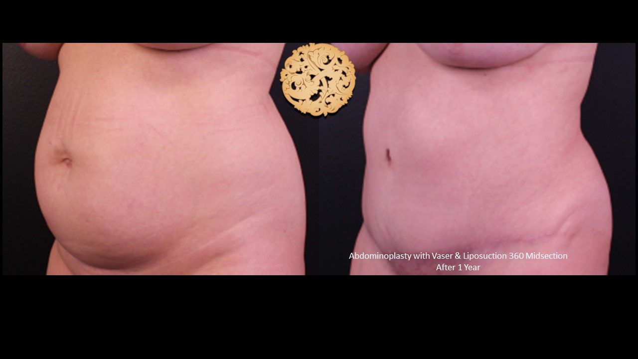 Tummy Tuck Before & After