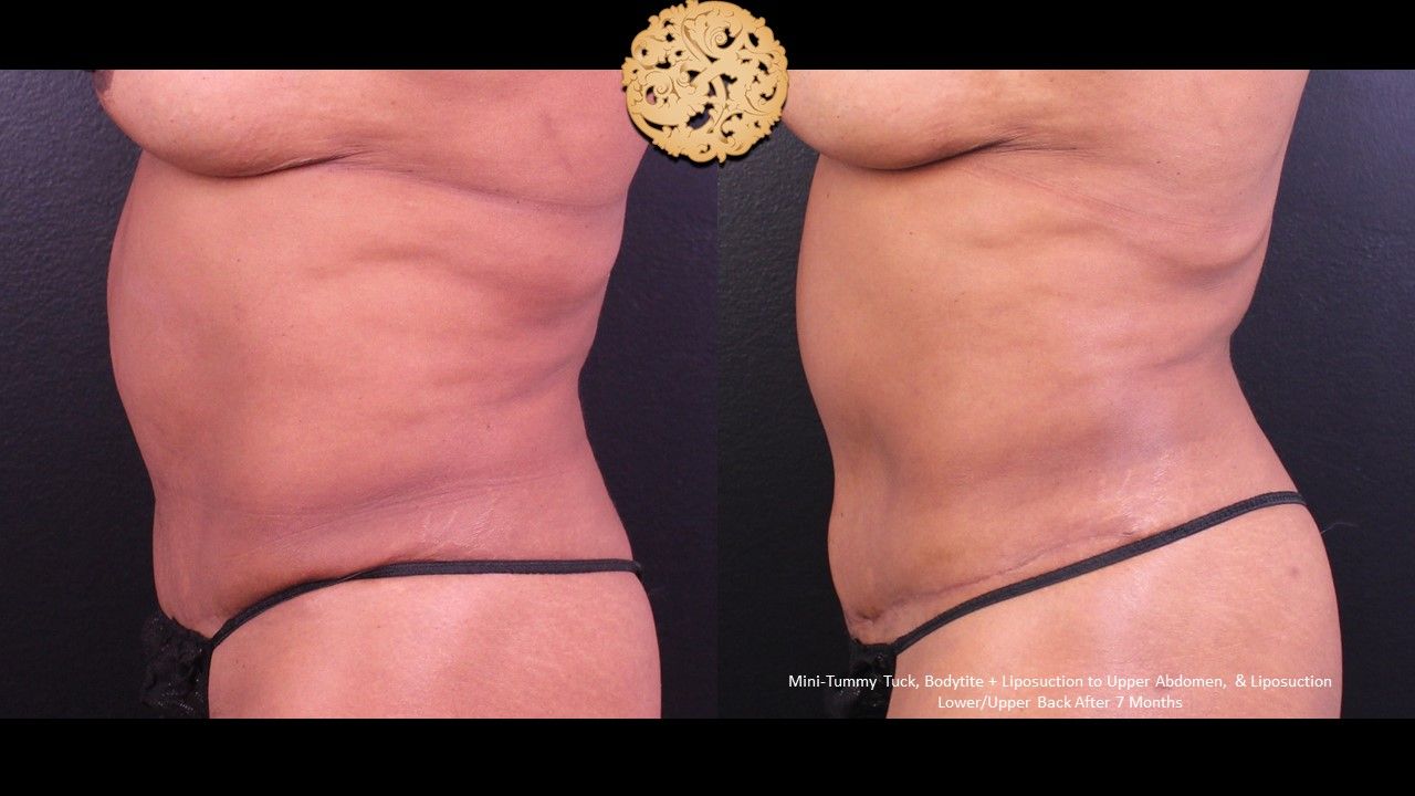 Tummy Tuck Before & After