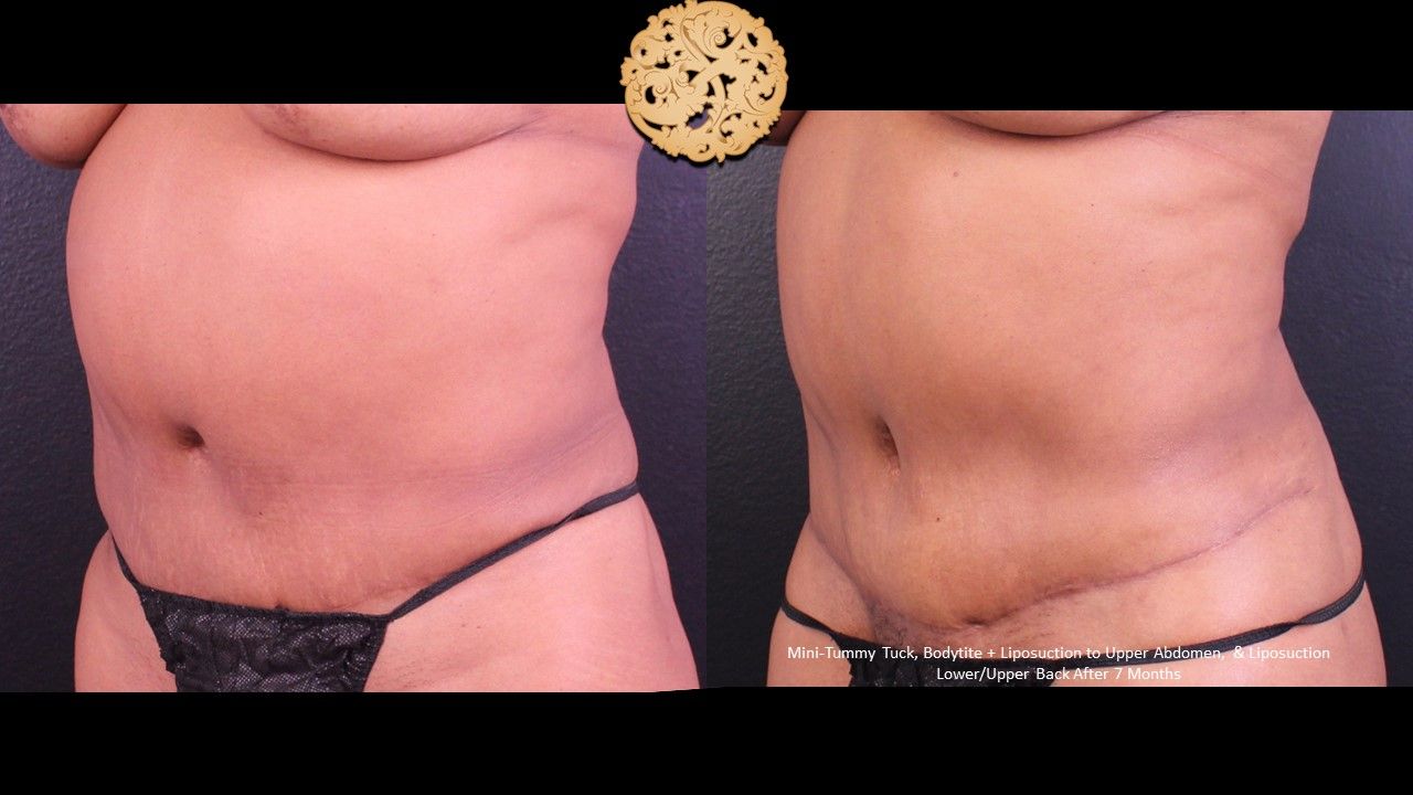 Tummy Tuck Before & After