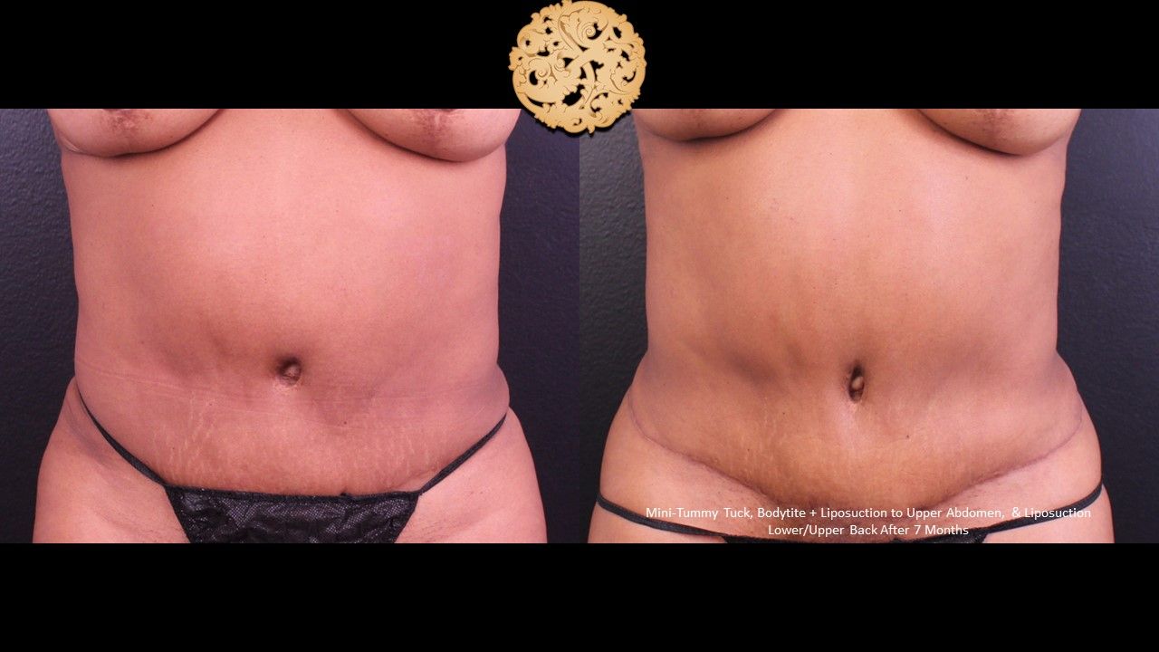 Tummy Tuck Before & After
