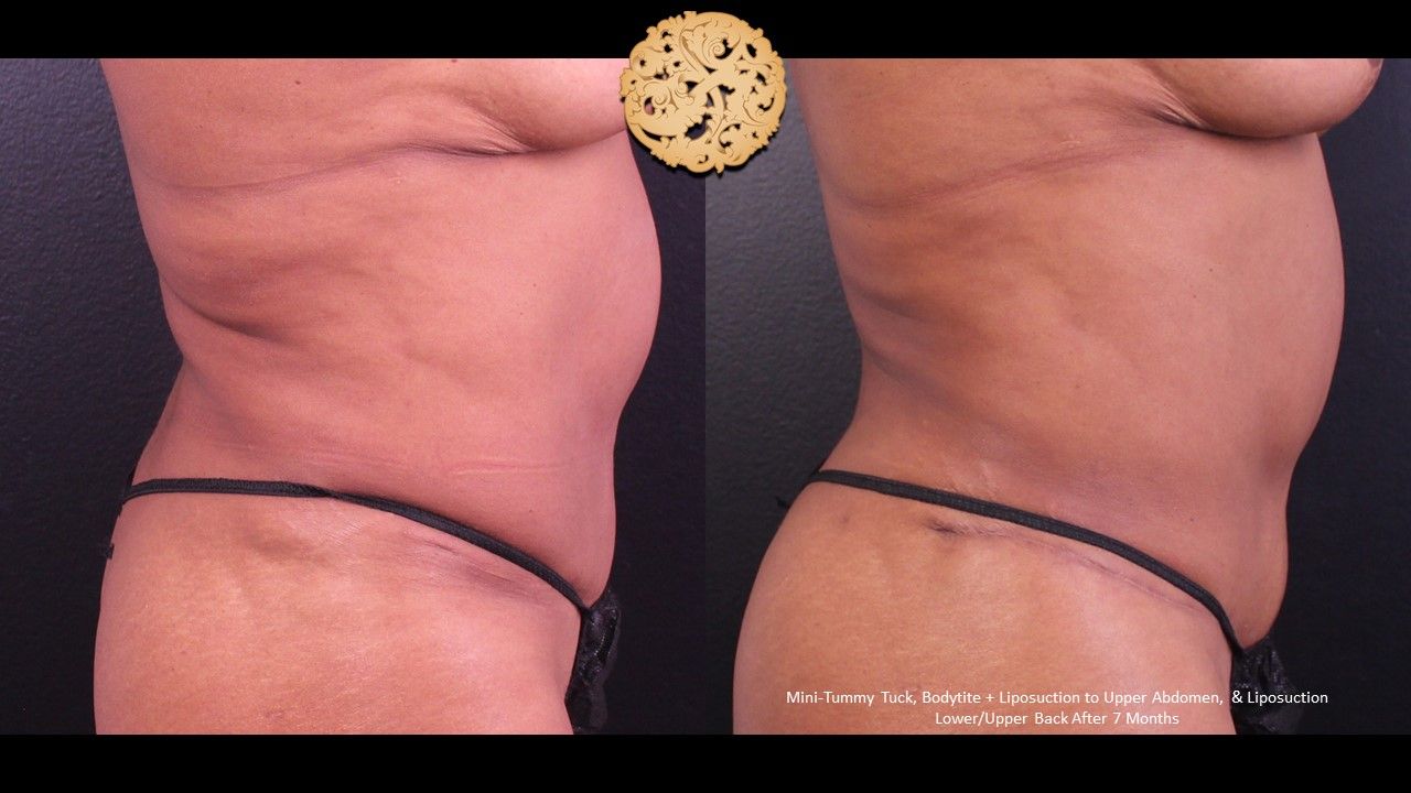 Tummy Tuck Before & After
