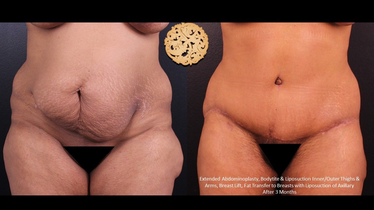 Tummy Tuck Before & After