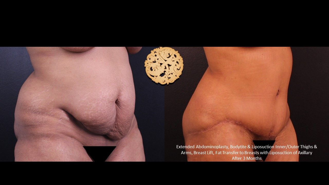 Tummy Tuck Before & After