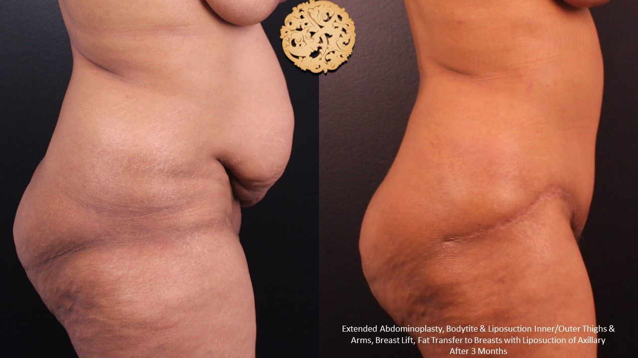 Tummy Tuck Before & After
