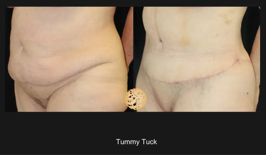 Tummy Tuck Before & After