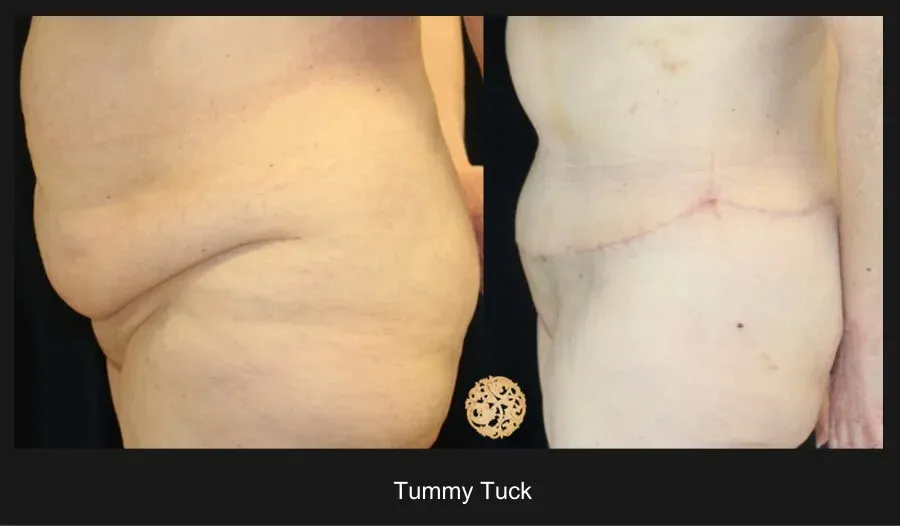 Tummy Tuck Before & After