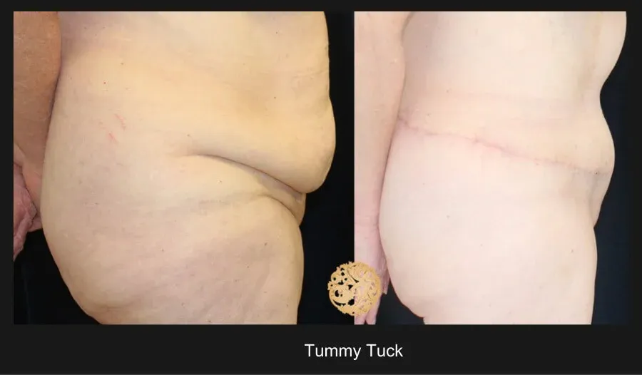 Tummy Tuck Before & After