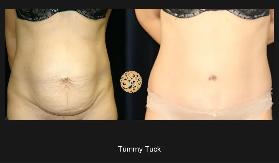 Tummy Tuck Before & After