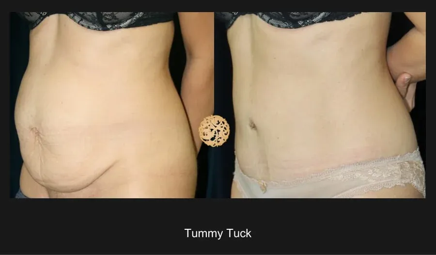 Tummy Tuck Before & After