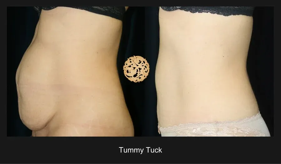 Tummy Tuck Before & After