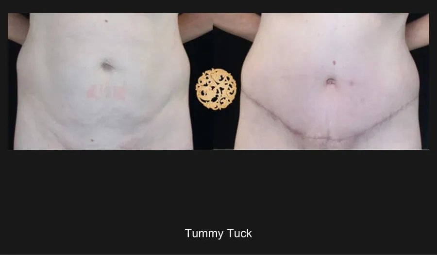 Tummy Tuck Before & After
