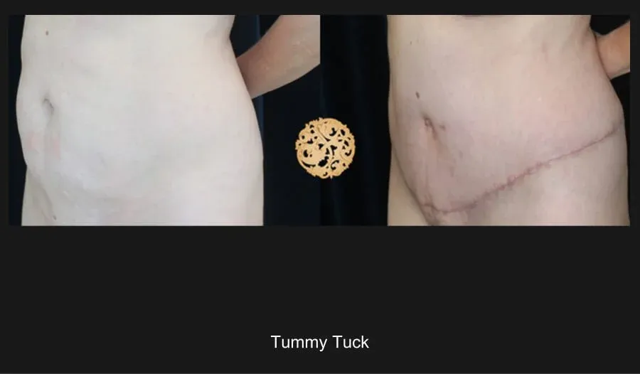 Tummy Tuck Before & After