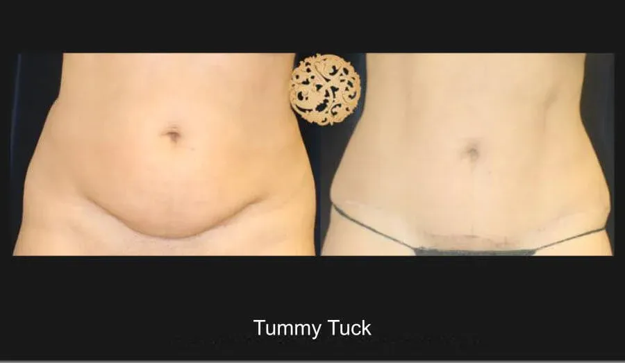 Tummy Tuck Before & After