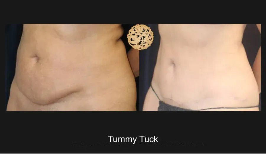Tummy Tuck Before & After