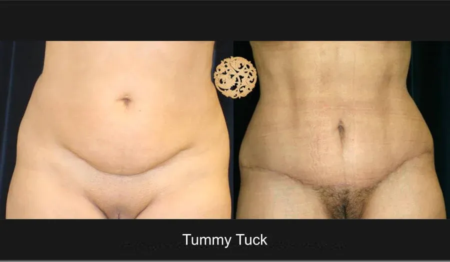 Tummy Tuck Before & After