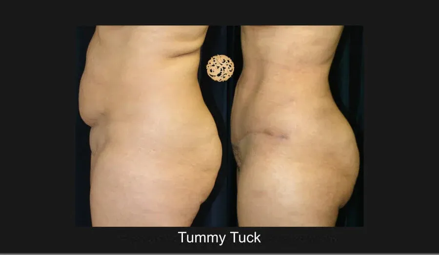 Tummy Tuck Before & After