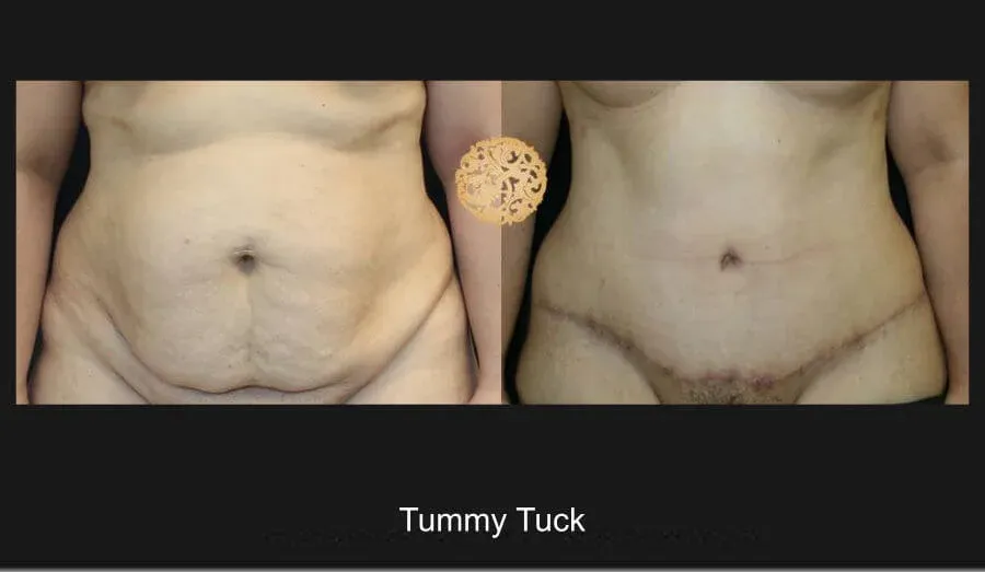 Tummy Tuck Before & After