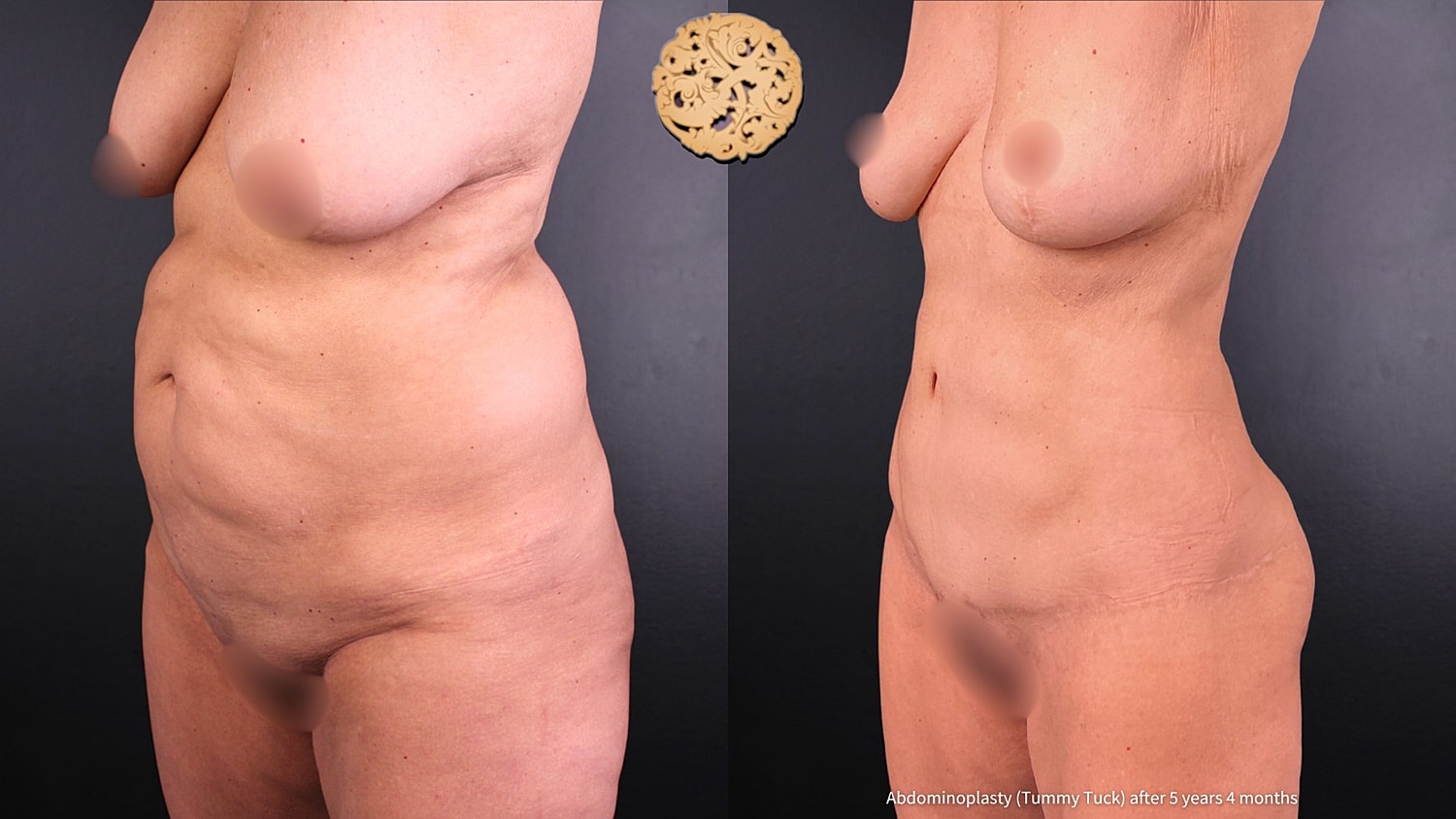 Tummy Tuck Before & After