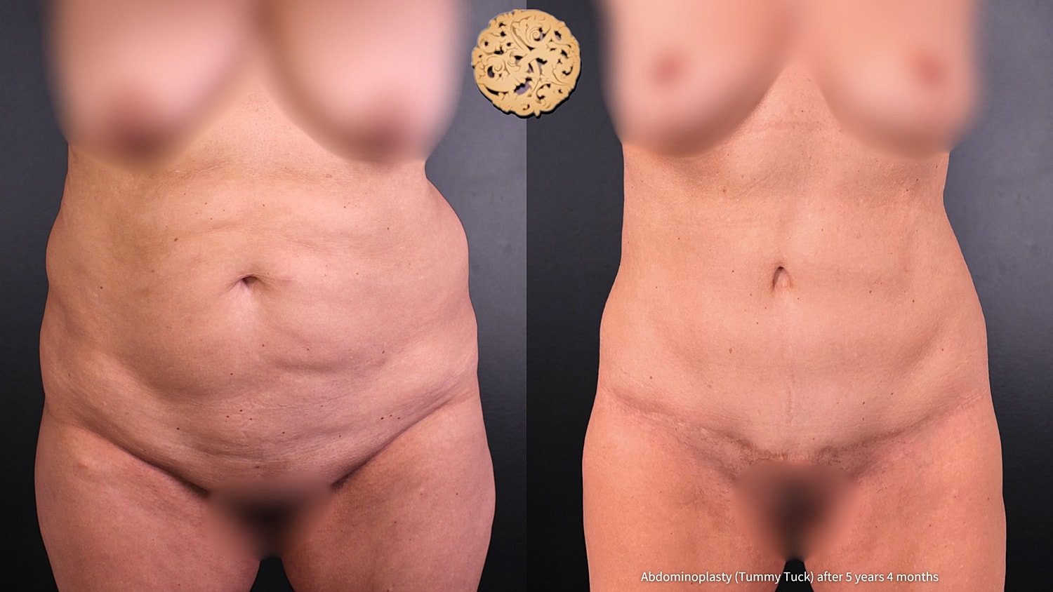 Tummy Tuck Before & After