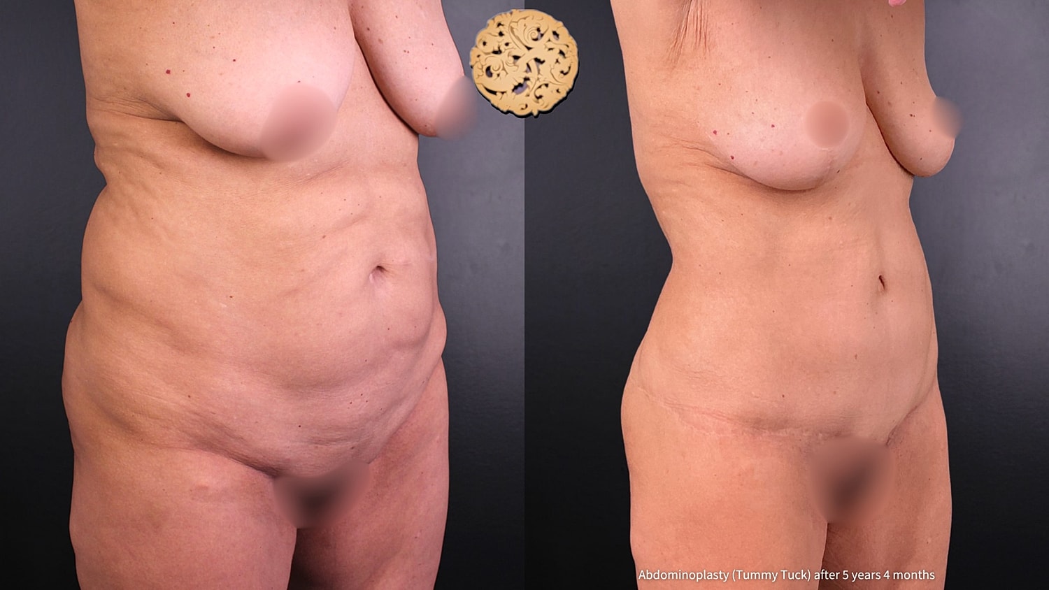 Tummy Tuck Before & After