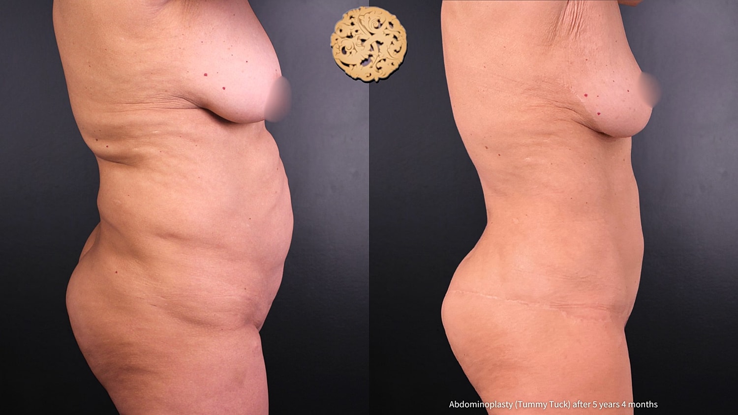 Tummy Tuck Before & After