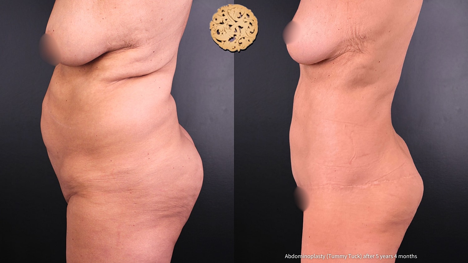 Tummy Tuck Before & After
