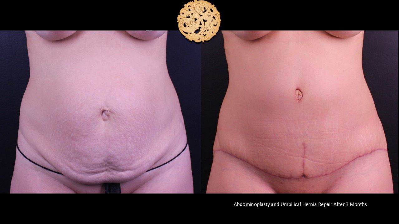 Tummy Tuck Before & After