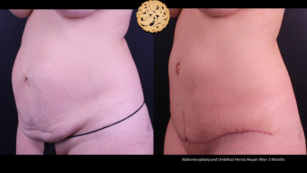Tummy Tuck Before & After