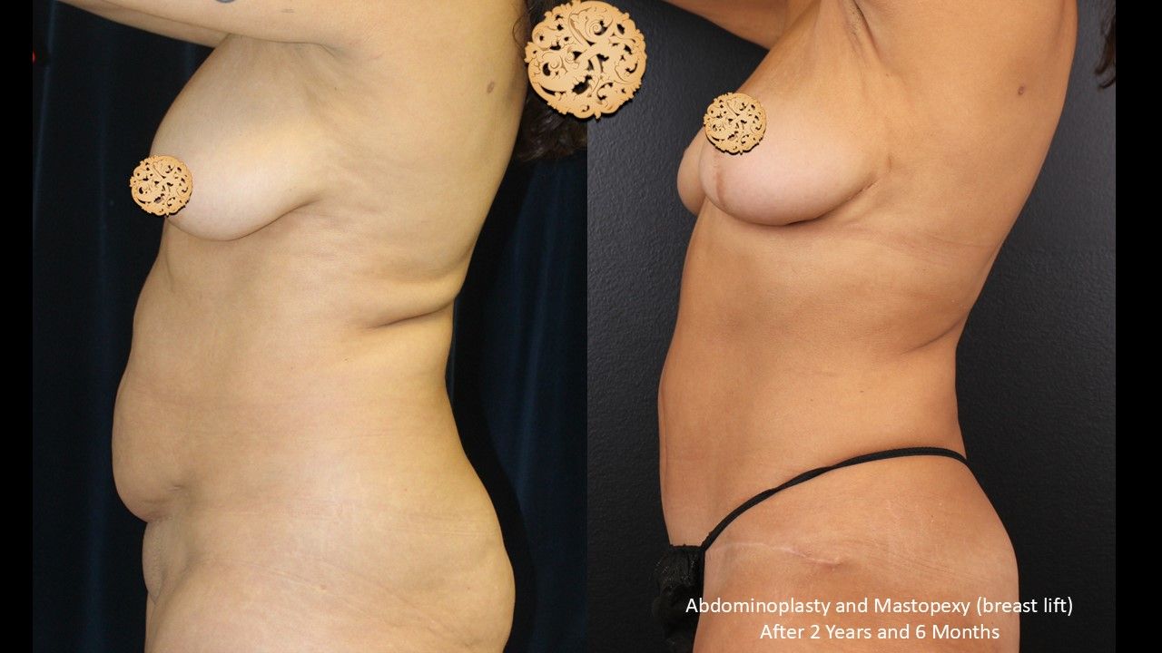 Tummy Tuck Before & After