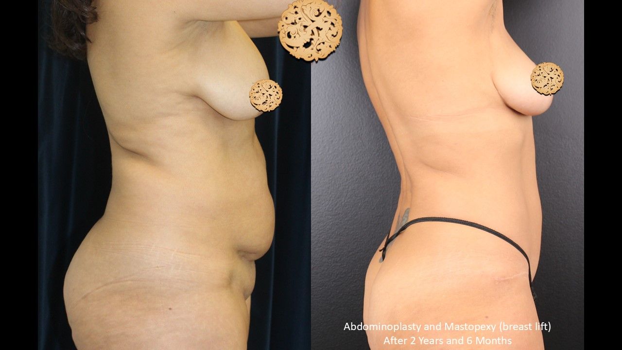Tummy Tuck Before & After