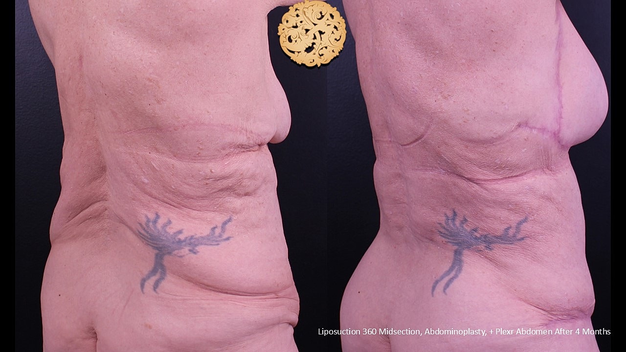 Tummy Tuck Before & After