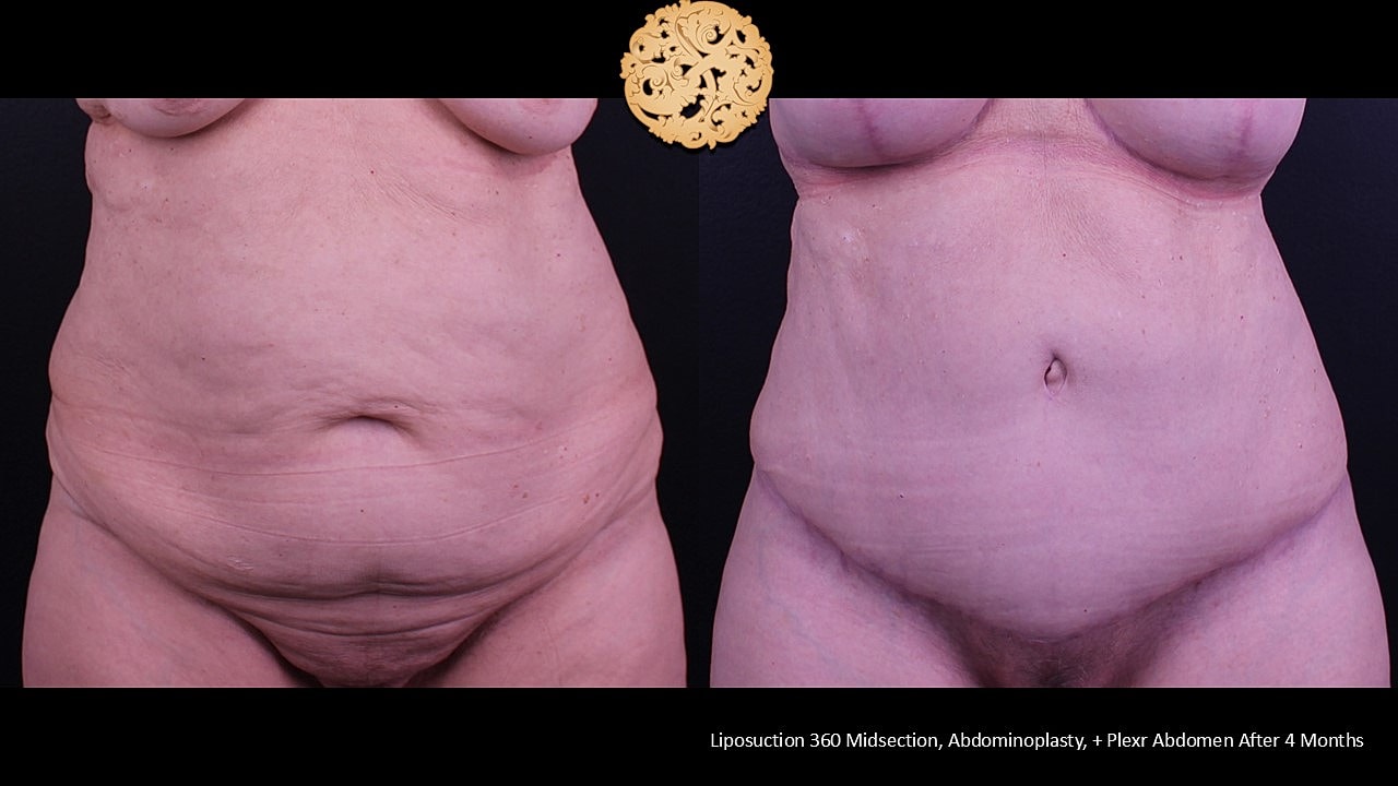 Tummy Tuck Before & After