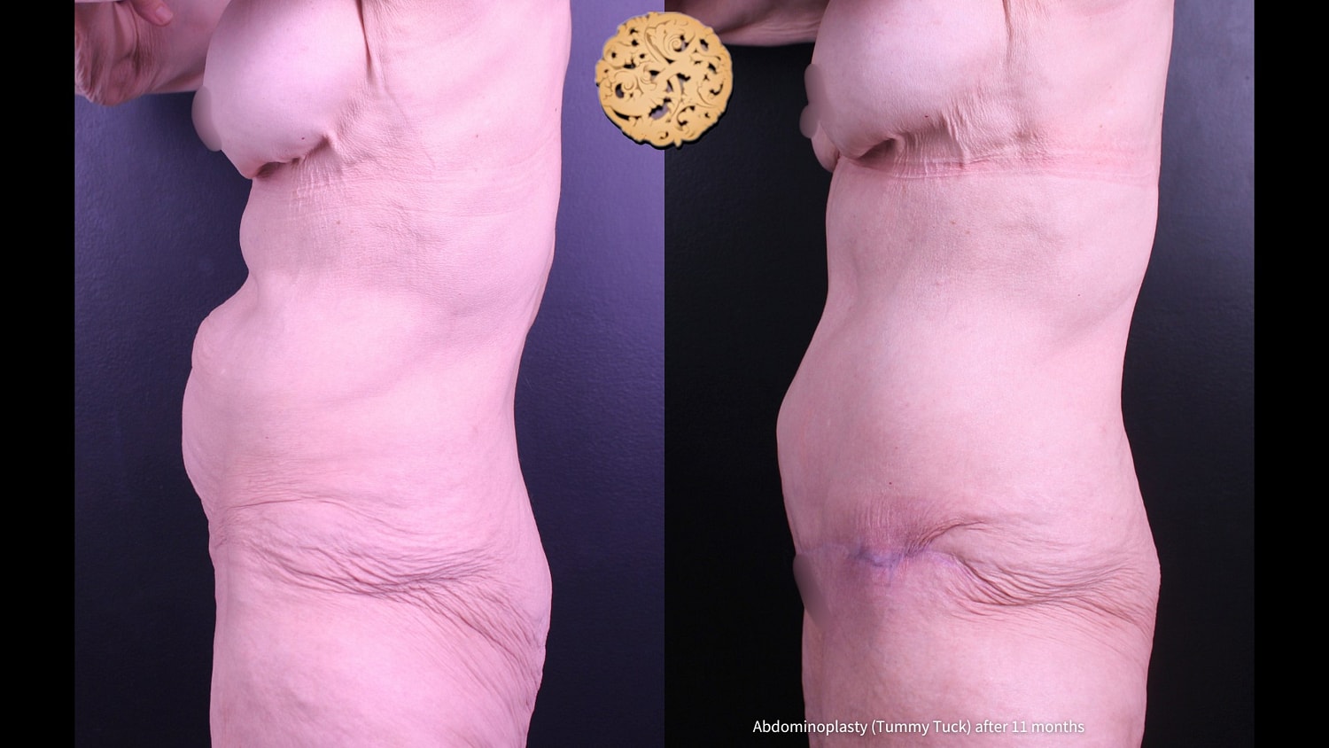 Tummy Tuck Before & After