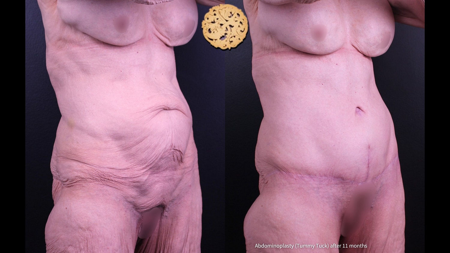 Tummy Tuck Before & After