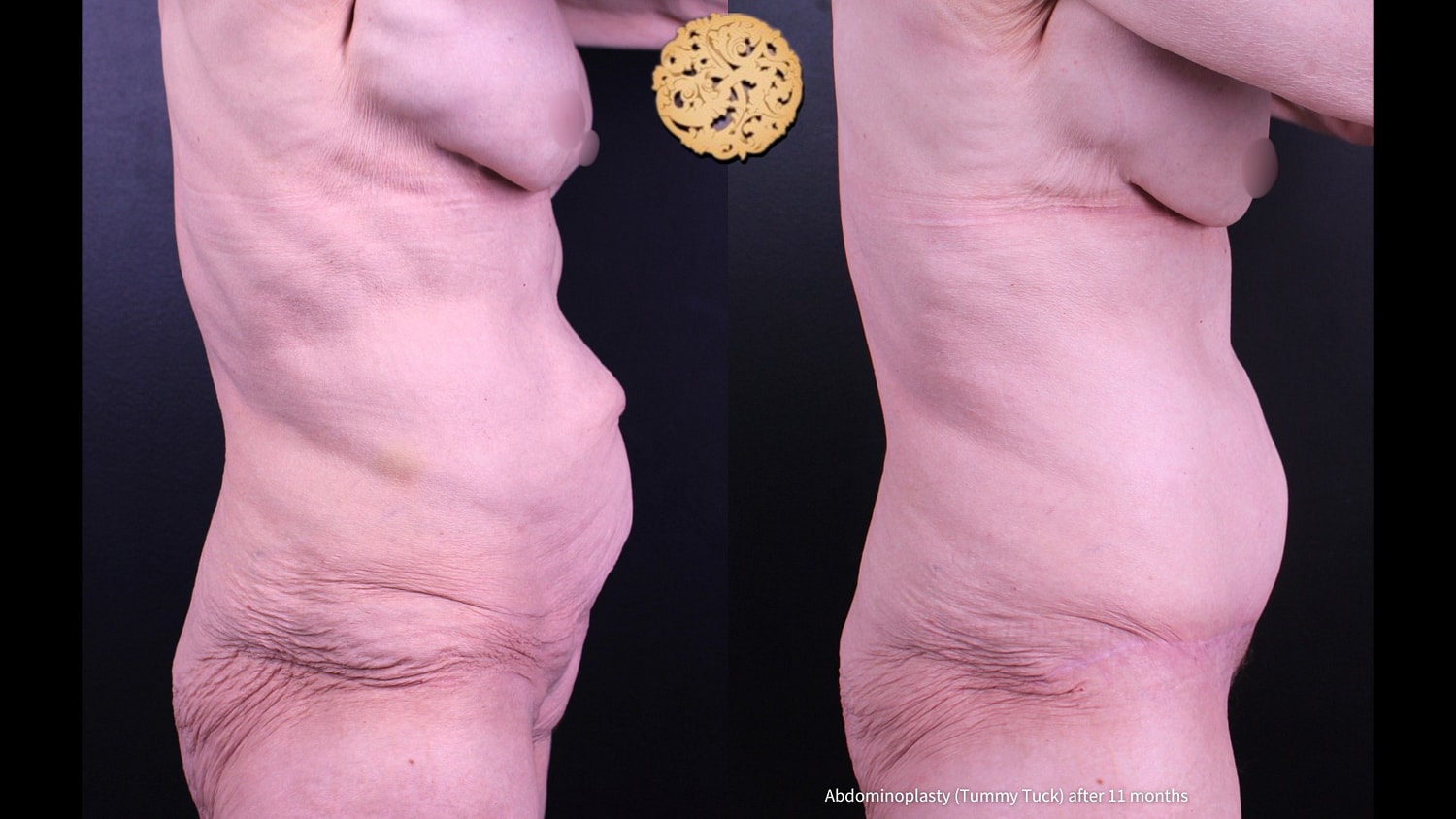 Tummy Tuck Before & After