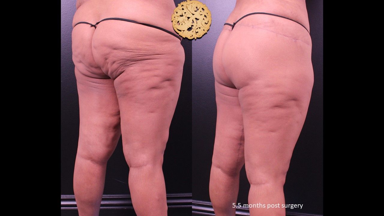 Thigh Lift Before & After