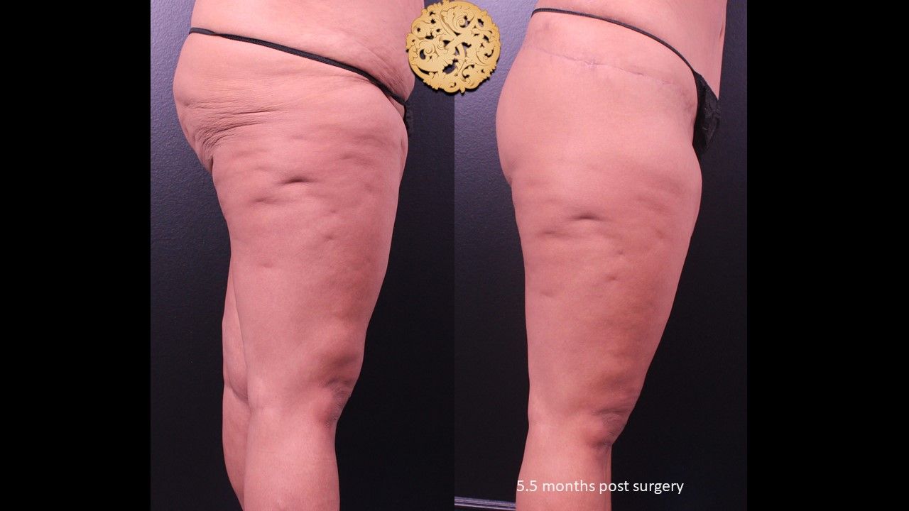 Thigh Lift Before & After
