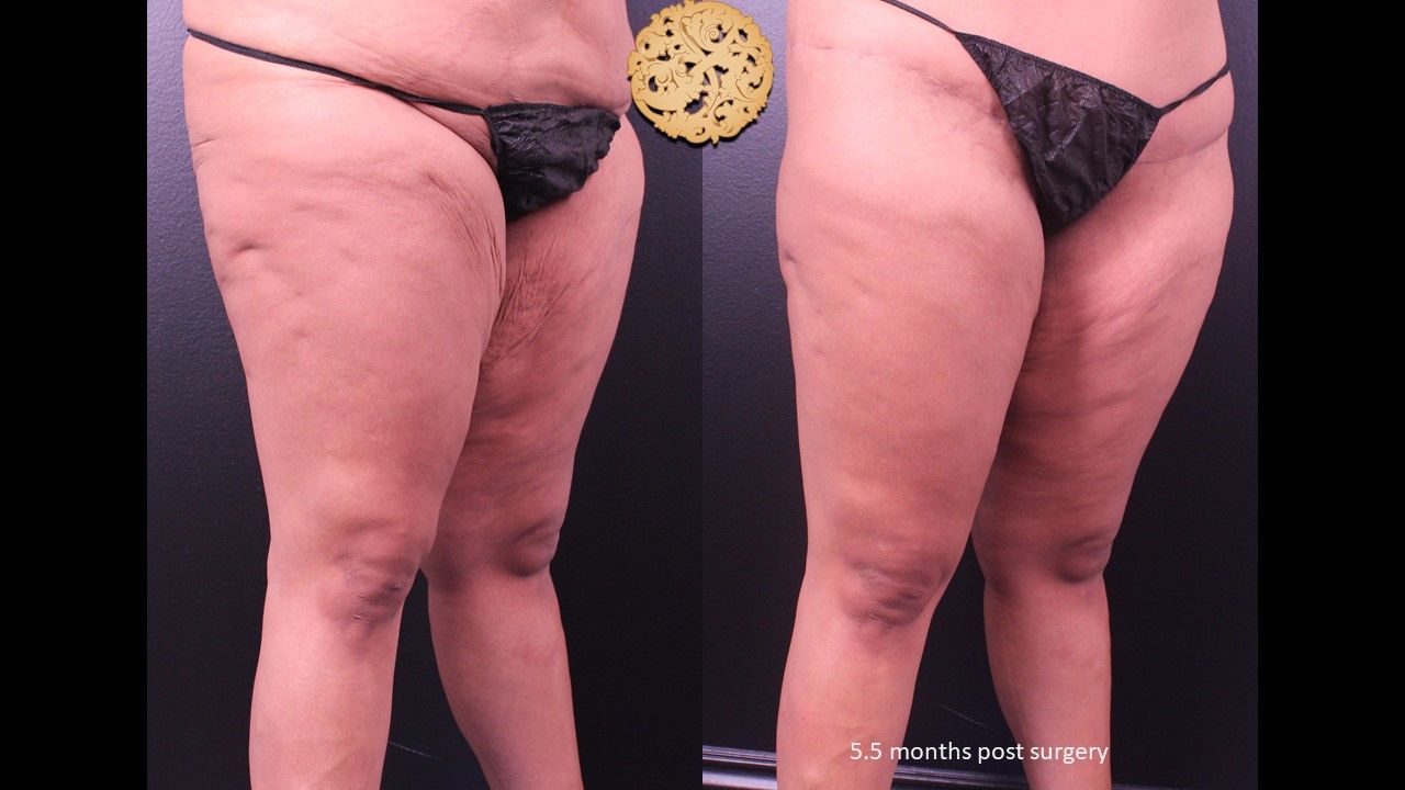 Thigh Lift Before & After