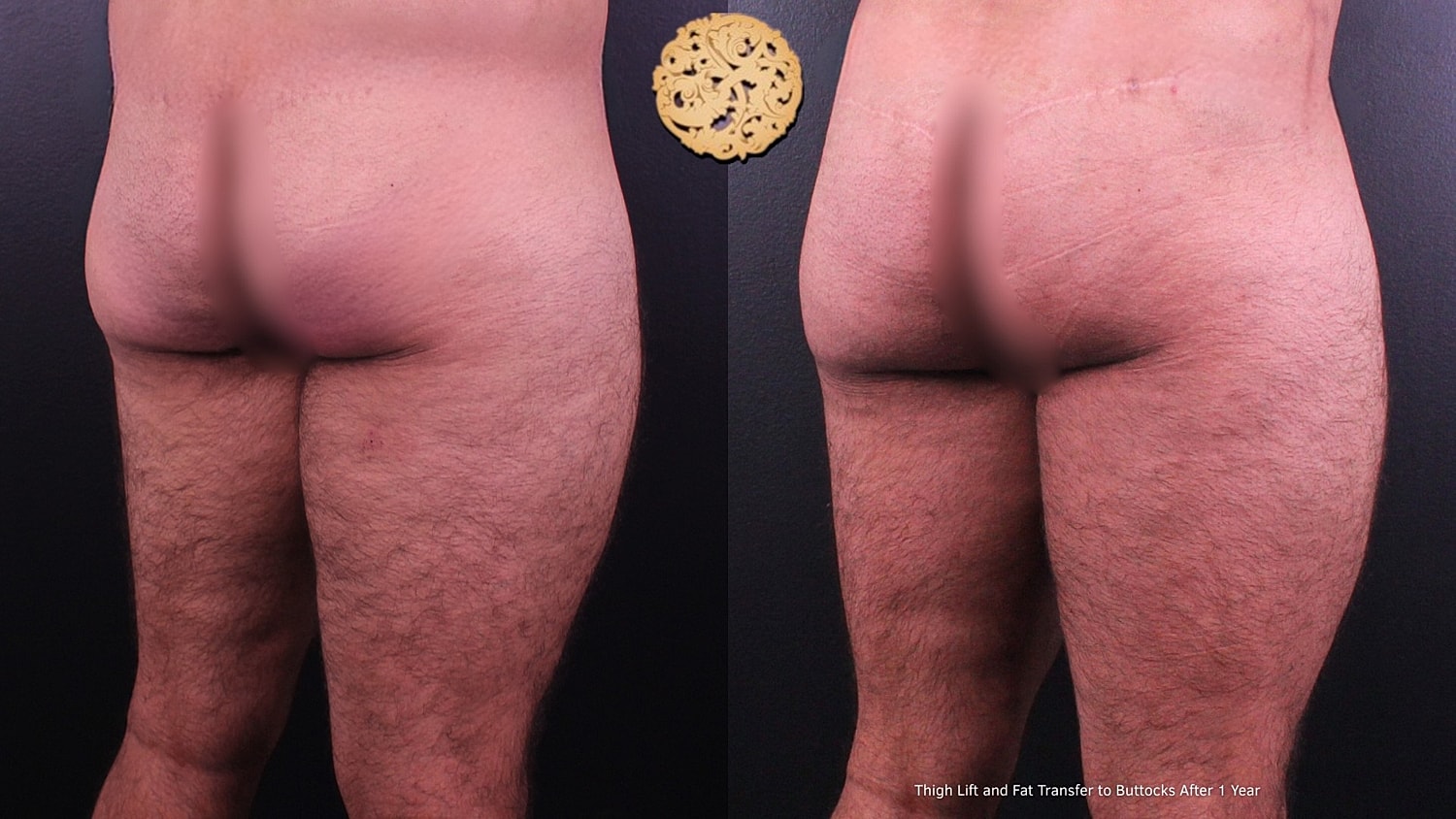 Thigh Lift Before & After