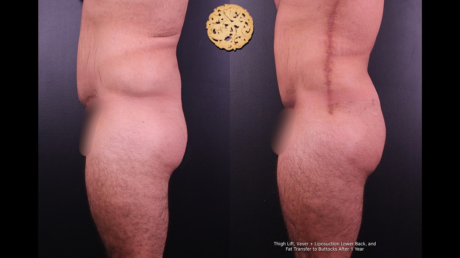 Thigh Lift Before & After