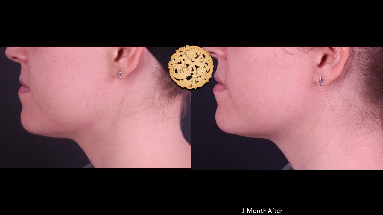 Accutite Before & After