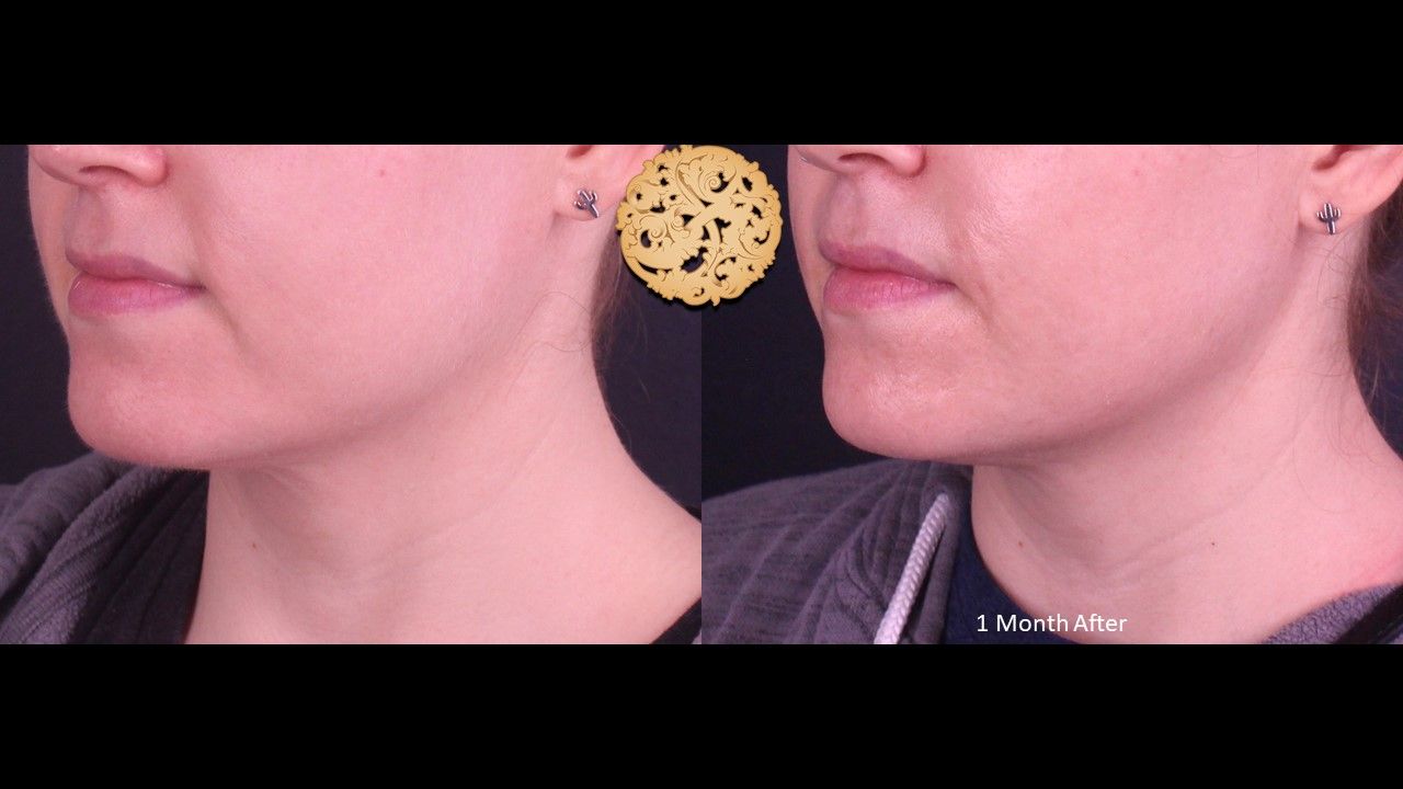 Accutite Before & After