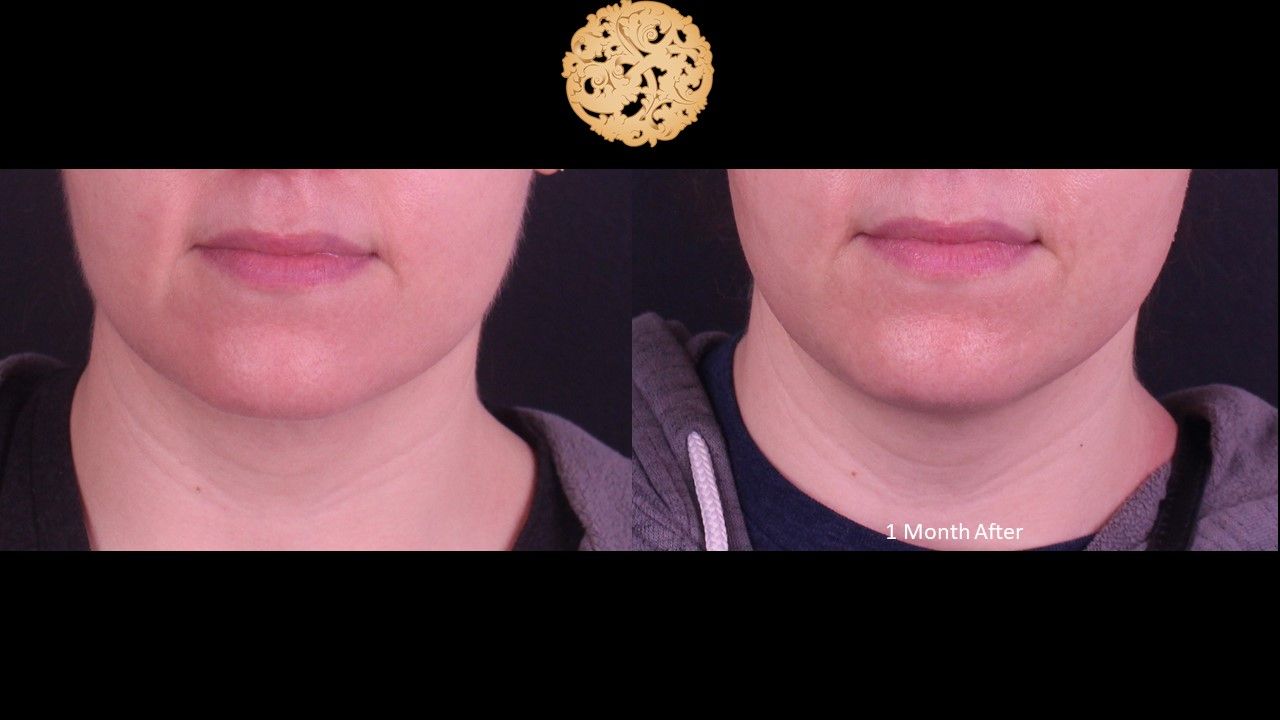Accutite Before & After