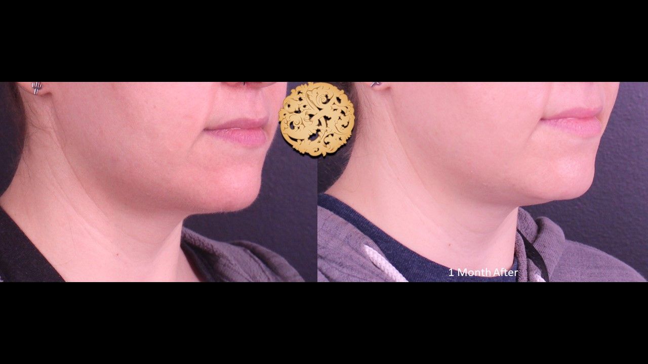 Accutite Before & After